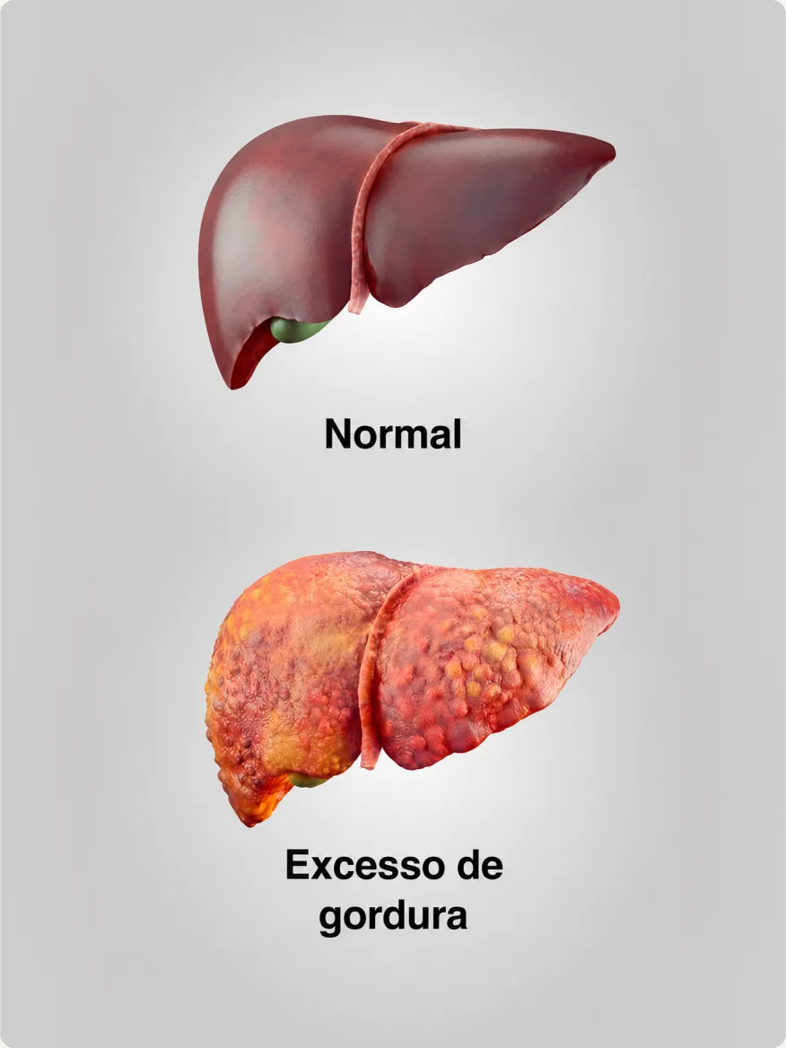 Comparação ilustrada entre um fígado normal e um fígado com excesso de gordura