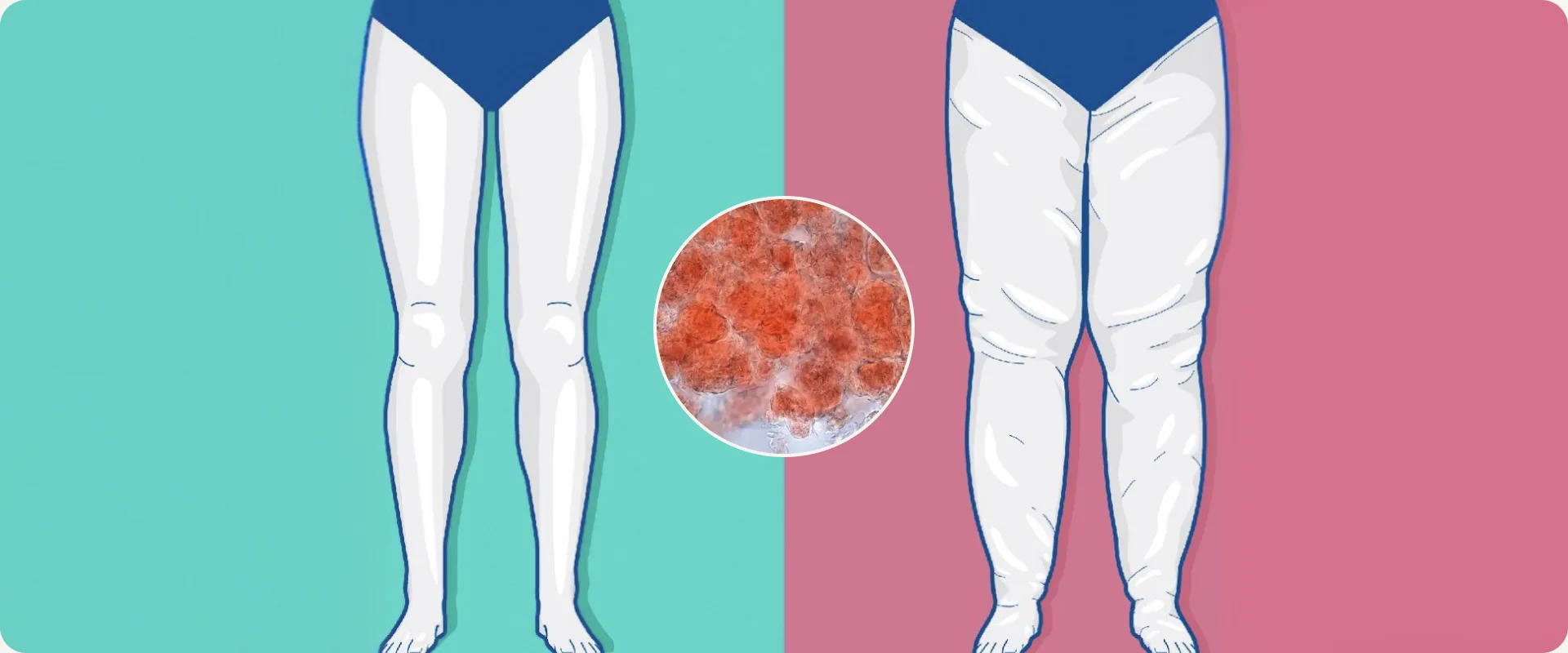 Ilustração comparando pernas saudáveis e pernas com lipedema, com destaque ampliado do tecido adiposo inflamado