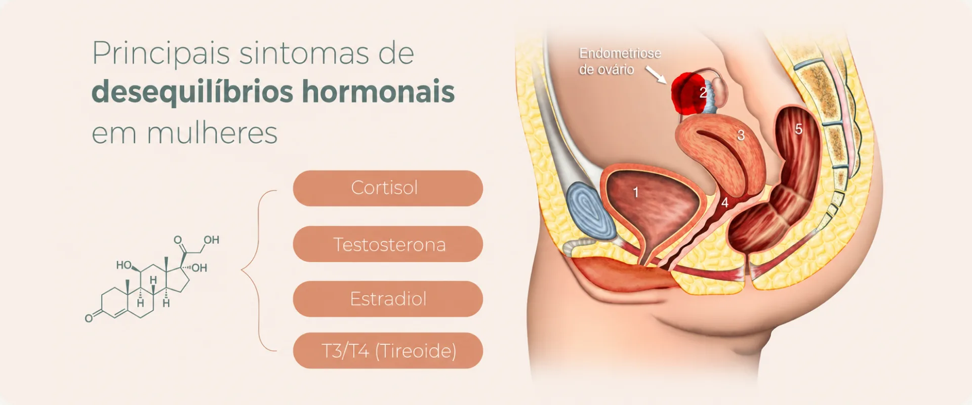Infográfico com os principais sintomas de desequilíbrios hormonais em mulheres: cortisol, testosterona, estradiol e T3/T4